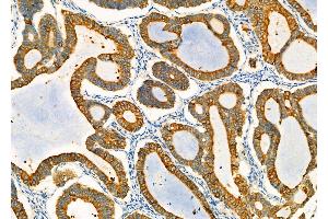 ABIN6259828 and ABIN6278001 at 1/100 staining Human ovarian cancer by IHC-P. (AGR2 anticorps  (N-Term))