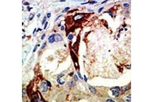 IHC analysis of FFPE human breast carcinoma tissue stained with the Myb antibody
