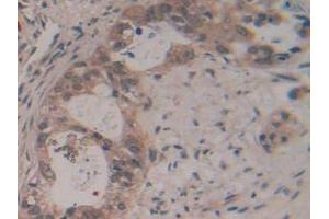 IHC-P analysis of Human Pancreas Cancer Tissue, with DAB staining. (GAP43 anticorps  (AA 1-274))