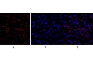 Immunofluorescence analysis of human breast cancer tissue.