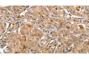 Immunohistochemistry of paraffin-embedded Human lung cancer tissue using RAP1A Polyclonal Antibody at dilution 1:45 (RAP1A anticorps)