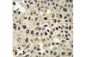 IHC analysis of FFPE human hepatocarcinoma stained with SSB antibody