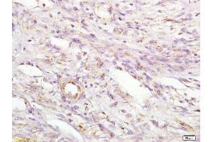 Formalin-fixed and paraffin embedded human cervical carcinoma labeled with Anti MIIP Polyclonal Antibody, Unconjugated  at 1:200 followed by conjugation to the secondary antibody and DAB staining (MIIP anticorps  (AA 251-350))