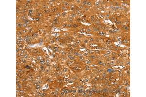 Immunohistochemistry of Human esophagus cancer using ABCC9 Polyclonal Antibody at dilution of 1:50 (ABCC9 anticorps)