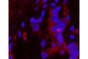 Immunofluorescence analysis of Human stomach cancer tissue using Cleaved-CASP1 (D210) Polyclonal Antibody at dilution of 1:200.