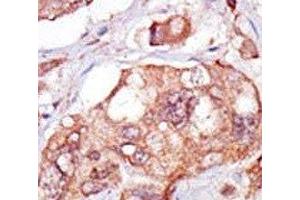 IHC analysis of FFPE human breast carcinoma tissue stained with the TNK1 antibody