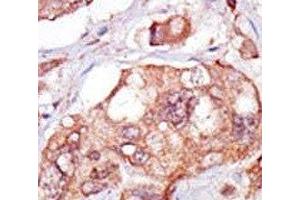 IHC analysis of FFPE human breast carcinoma tissue stained with the TNK1 antibody (TNK1 anticorps  (AA 256-286))