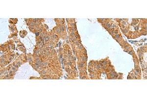 Immunohistochemistry of paraffin-embedded Human thyroid cancer tissue using ITGB1BP1 Polyclonal Antibody at dilution of 1:50(x200) (ITGB1BP1 anticorps)