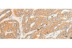 Immunohistochemistry of paraffin-embedded Human liver cancer tissue using CYP3A43 Polyclonal Antibody at dilution of 1:30(x200)