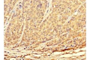 Immunohistochemistry of paraffin-embedded human ovarian cancer using ABIN7172897 at dilution of 1:100 (TKTL2 anticorps  (AA 1-300))