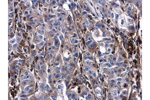IHC-P Image Urokinase antibody detects Urokinase protein at cytoplasm and extracellular space in human esophageal carcinoma by immunohistochemical analysis. (PLAU anticorps)