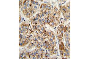 Formalin-fixed and paraffin-embedded human hepatocarcinoma with MCCC2 Antibody (Center), which was peroxidase-conjugated to the secondary antibody, followed by DAB staining. (MCCC2 anticorps  (AA 163-189))