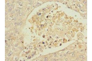 Immunohistochemistry of paraffin-embedded human lung cancer using ABIN7157058 at dilution of 1:100