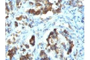 IHC testing of FFPE human gastric carcinoma with Cdc20 antibody (clone CLDC20-1) (CDC20 anticorps)