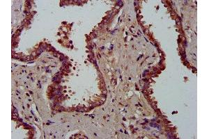 IHC image of ABIN7159706 diluted at 1:300 and staining in paraffin-embedded human prostate cancer performed on a Leica BondTM system. (MFAP4 anticorps  (AA 100-191))