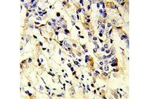 IHC analysis of FFPE human breast carcinoma stained with IGHM antibody (IGHM anticorps  (AA 103-131))