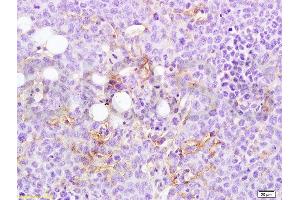 Formalin-fixed and paraffin embedded rat transplantation tumor tissue labeled with Anti-MTUS1 Polyclonal Antibody, Unconjugated  at 1:200 followed by conjugation to the secondary antibody and DAB staining
