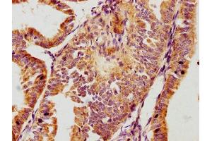 IHC image of ABIN7163242 diluted at 1:100 and staining in paraffin-embedded human endometrial cancer performed on a Leica BondTM system. (GPLD1 anticorps  (AA 310-565))