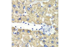 Immunohistochemistry of paraffin-embedded human liver injury using ABAT antibody.