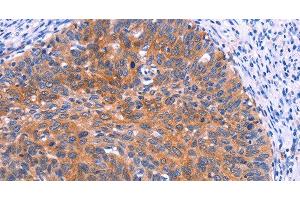 Immunohistochemistry of paraffin-embedded Human cervical cancer tissue using PTPN13 Polyclonal Antibody at dilution 1:30 (PTPN13 anticorps)
