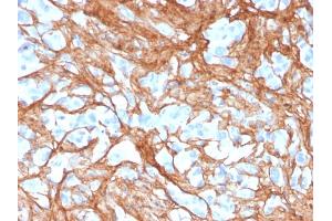 Formalin-fixed, paraffin-embedded human colon carcinoma stained with Periostin (POSTN) Mouse Monoclonal Antibody (POSTN/3501). (Periostin anticorps  (AA 193-326))