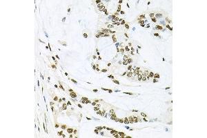 Immunohistochemistry of paraffin-embedded human gastric cancer using MAPK8 antibody.