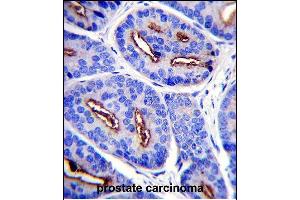 FOLH1 Antibody (N-term) (ABIN657630 and ABIN2846626) immunohistochemistry analysis in formalin fixed and paraffin embedded human prostate carcinoma followed by peroxidase conjugation of the secondary antibody and DAB staining. (PSMA anticorps  (N-Term))