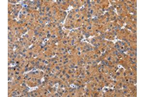 The image on the left is immunohistochemistry of paraffin-embedded Human liver cancer tissue using ABIN7193094(ZFAND2A Antibody) at dilution 1/30, on the right is treated with synthetic peptide. (ZFAND2A anticorps)