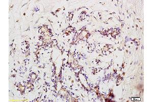 Formalin-fixed and paraffin embedded human pneumonia tissue labeled with Anti-Phospho-IRAK1 (Ser376) Polyclonal Antibody, Unconjugated at 1:200 followed by conjugation to the secondary antibody and DAB staining (IRAK1 anticorps  (pSer376))