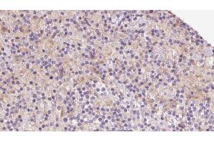 ABIN6273080 at 1/100 staining Human lymph cancer tissue by IHC-P. (TIMM22 anticorps  (Internal Region))