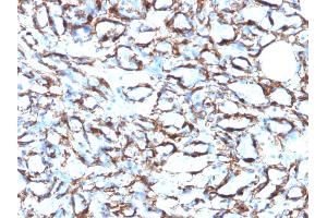 Formalin-fixed, paraffin-embedded human Angiosarcoma stained with Smooth Muscle Actin MAb (1A4 + ACTA2/791).