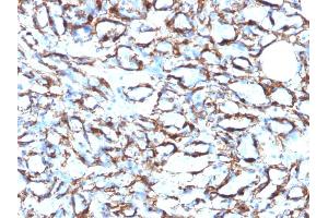 Formalin-fixed, paraffin-embedded human Angiosarcoma stained with Smooth Muscle Actin MAb (1A4 + ACTA2/791).