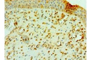 Immunohistochemistry of paraffin-embedded human prostate cancer using ABIN7147105 at dilution of 1:100 (CNOT8 anticorps  (AA 1-292))