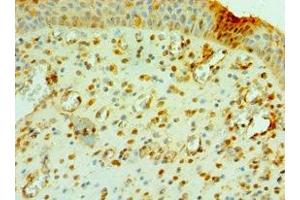 Immunohistochemistry of paraffin-embedded human prostate cancer using ABIN7147105 at dilution of 1:100