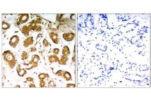 Immunohistochemical analysis of paraffin-embedded human breast carcinoma tissue using NFκB-p65 (Ab-505) Antibody (E021178). (NF-kB p65 anticorps)