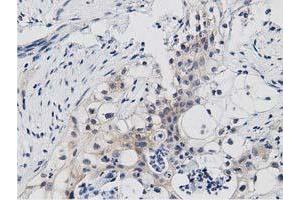 Immunohistochemical staining of paraffin-embedded Carcinoma of Human pancreas tissue using anti-PRKD2 mouse monoclonal antibody. (PKD2 anticorps)