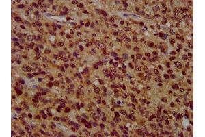 IHC image of ABIN7176659 diluted at 1:400 and staining in paraffin-embedded human glioma performed on a Leica BondTM system. (ZFX anticorps  (AA 711-805))