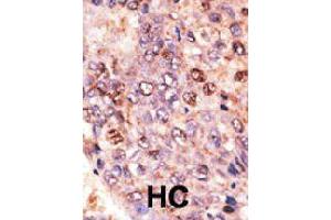 Formalin-fixed and paraffin-embedded human hepatocellular carcinoma tissue reacted with ABCB7 polyclonal antibody  , which was peroxidase-conjugated to the secondary antibody, followed by DAB staining. (ABCB7 anticorps  (C-Term))