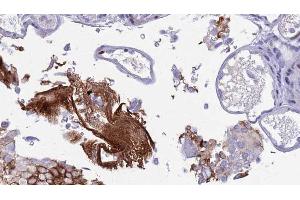 ABIN6273452 at 1/100 staining Human urothelial cancer tissue by IHC-P.