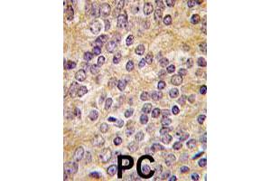 Formalin-fixed and paraffin-embedded human prostate carcinoma tissue reacted with PLAU polyclonal antibody  , which was peroxidase-conjugated to the secondary antibody, followed by DAB staining. (PLAU anticorps  (C-Term))