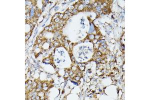 Immunohistochemistry of paraffin-embedded human colon carcinoma using MTIF2 antibody (ABIN7268591) at dilution of 1:100 (40x lens).