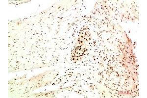 Immunohistochemical analysis of paraffin-embedded Human Colon Carcinoma Tissue using HP-1 α Mouse mAb diluted at 1:200. (CBX5 anticorps)