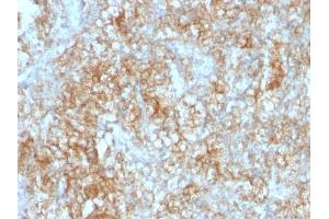 Formalin-fixed, paraffin-embedded human Renal Cell Carcinoma stained with CD147 Mouse Monoclonal Antibody (8D6).