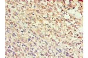 Immunohistochemistry of paraffin-embedded human melanoma using ABIN7145991 at dilution of 1:100 (CCL25 anticorps  (AA 24-150))
