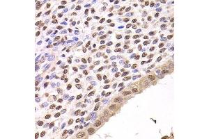 Immunohistochemistry of paraffin-embedded human adenomyosis using FKBP4 Antibody.