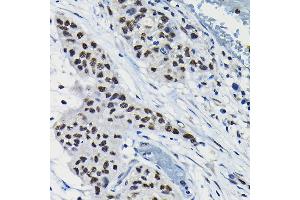 Immunohistochemistry of paraffin-embedded human lung cancer using A Rabbit pAb (ABIN6131196, ABIN6137102, ABIN6137103 and ABIN6223591) at dilution of 1:100 (40x lens). (ARID3A anticorps  (AA 324-593))