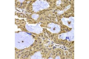 Immunohistochemistry of paraffin-embedded human oophoroma using XPO5 antibody.