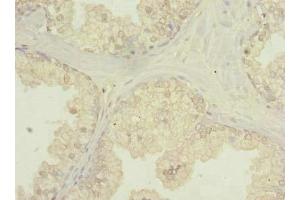 Immunohistochemistry of paraffin-embedded human prostate cancer using ABIN7174808 at dilution of 1:100 (C20orf195 anticorps  (AA 10-310))