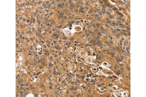 Immunohistochemistry (IHC) image for anti-Synovial Sarcoma, X Breakpoint 2 Interacting Protein (SSX2IP) antibody (ABIN2430871)