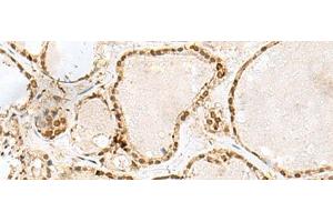 Immunohistochemistry of paraffin-embedded Human thyroid cancer tissue using GTF3C2 Polyclonal Antibody at dilution of 1:45(x200)